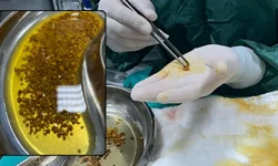 "DOKTORLAR BİLE ŞAŞIRDI: SAFRA KESESİNDEN 2 BİN 67 TAŞ ÇIKTI"