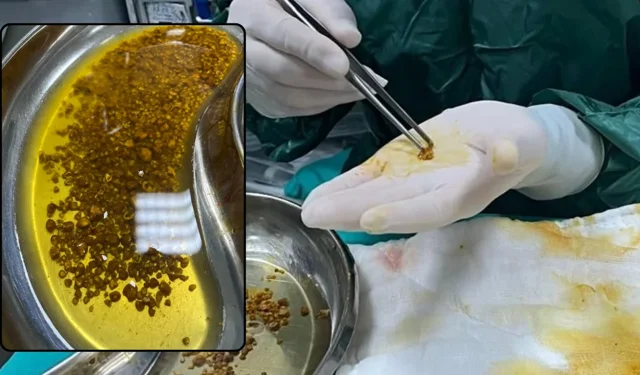 "DOKTORLAR BİLE ŞAŞIRDI: SAFRA KESESİNDEN 2 BİN 67 TAŞ ÇIKTI"